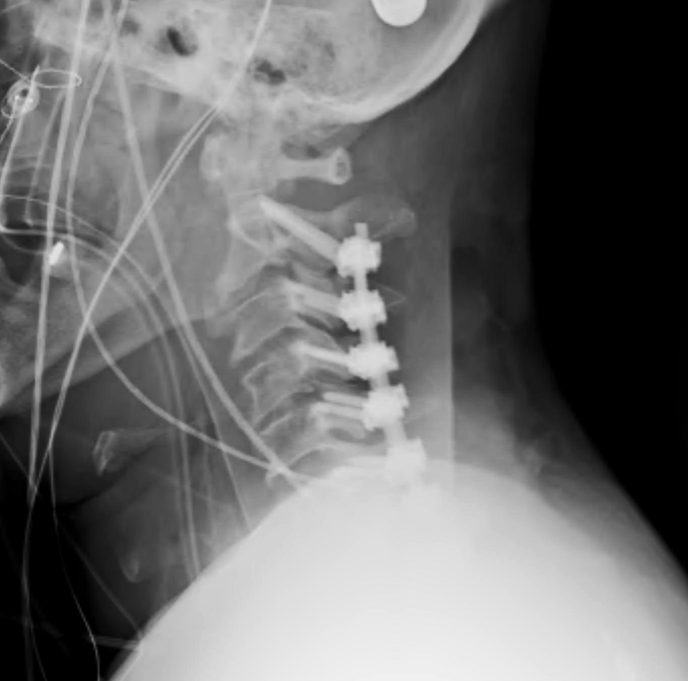 Unilateral Facet Dislocation Posterior Stabilisation